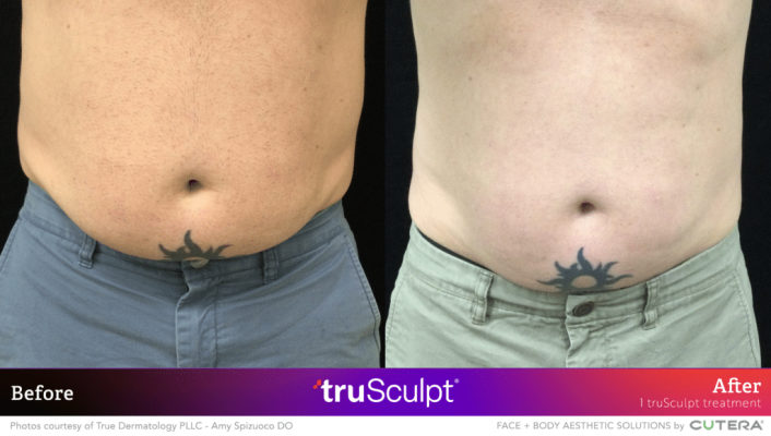 03_truSculpt-ID_BA_True-Dermatology-1024x580