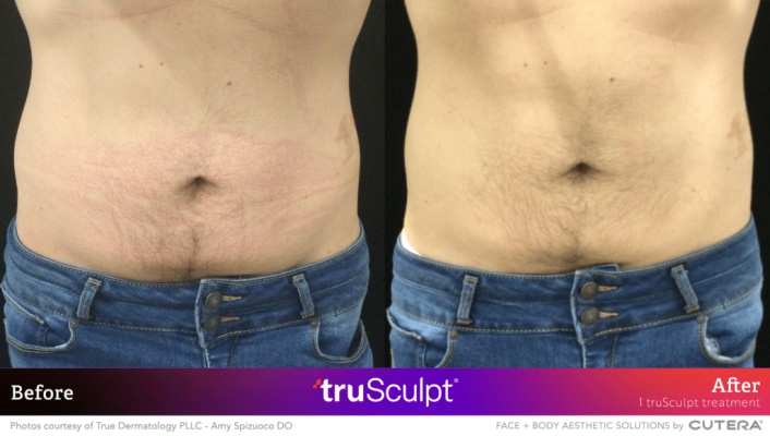 04_truSculpt-ID_BA_True-Dermatology-1024x580