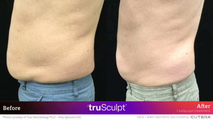 05_truSculpt-ID_BA_True-Dermatology-1024x580