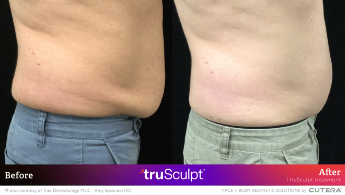 06_truSculpt-ID_BA_True-Dermatology-1024x580